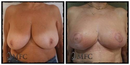 Elevaci�?�?�?�??�?�??�?³n de pecho